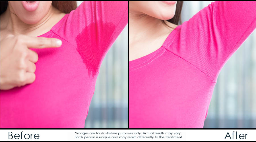 before-after-excessive-sweating