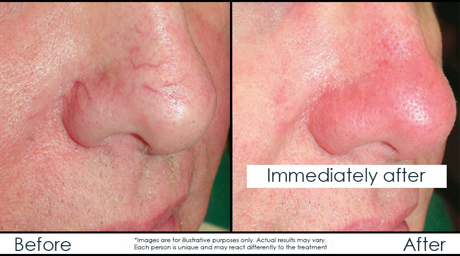 before-after-laser-veins-en