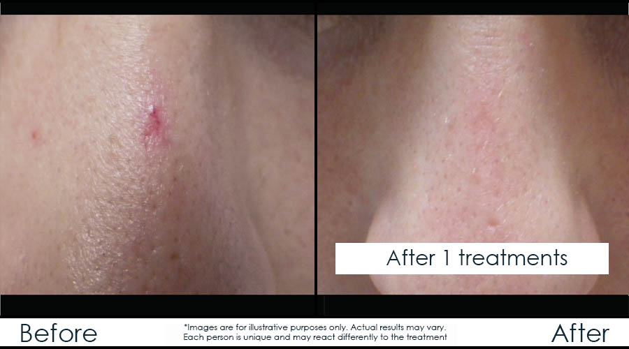 before-after-laser-veins-en4