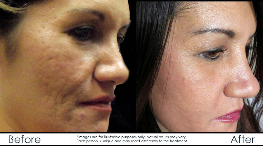 Microneedling