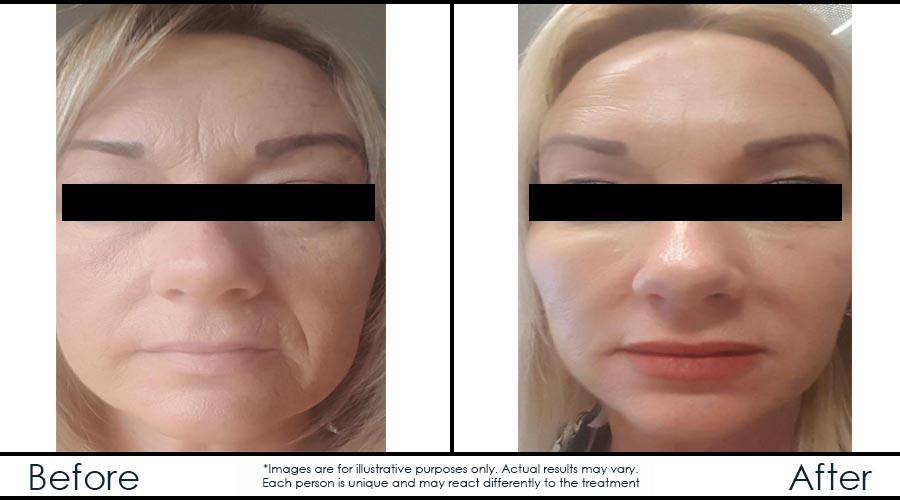 before-afteren-juvederm-en