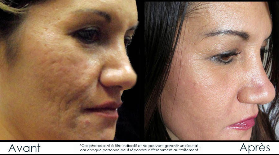 before-afterfr-microneedling