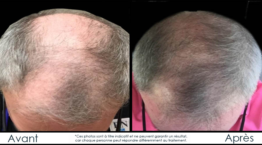 Perte de cheveux | Clinique Infinium | Hull, Gatineau, Ottawa