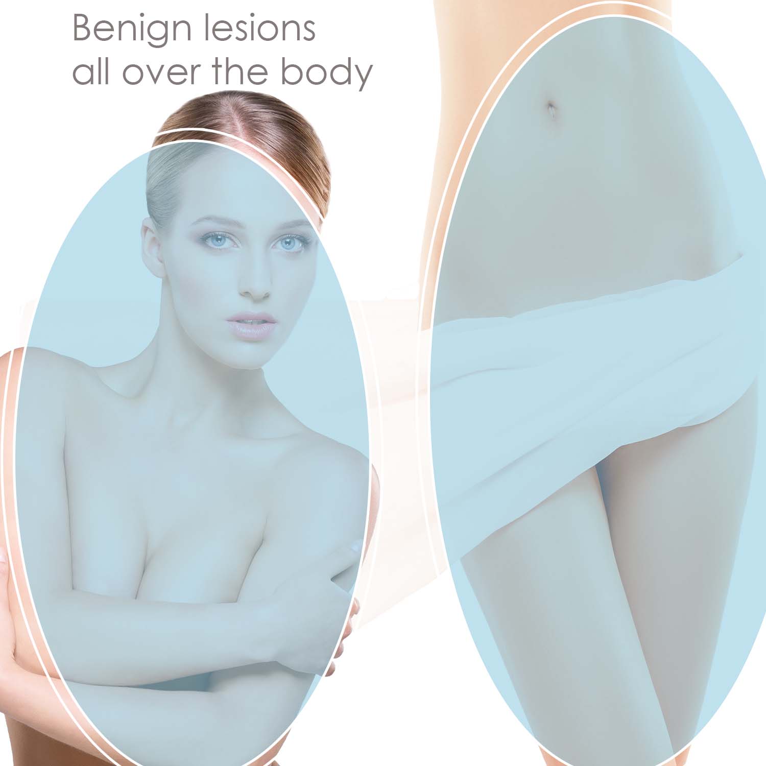 bening-lesion-thermocoagulation