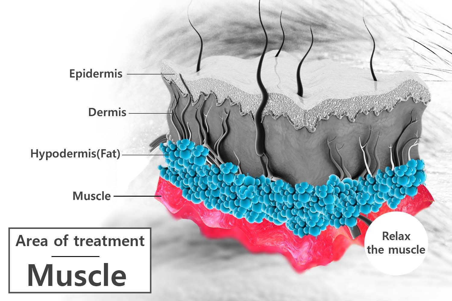 Botox-muscle-treatment-area Botox-muscle-treatment-area