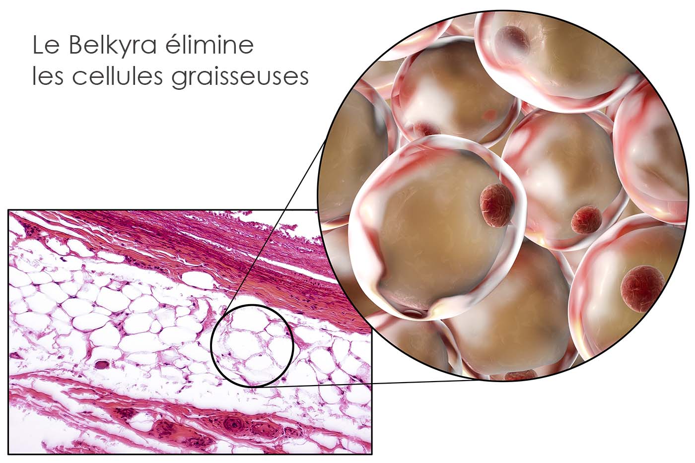 Cellule grasse – Belkyra-reduction du gras