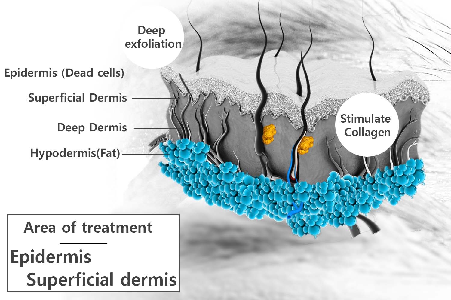 chemical-peel