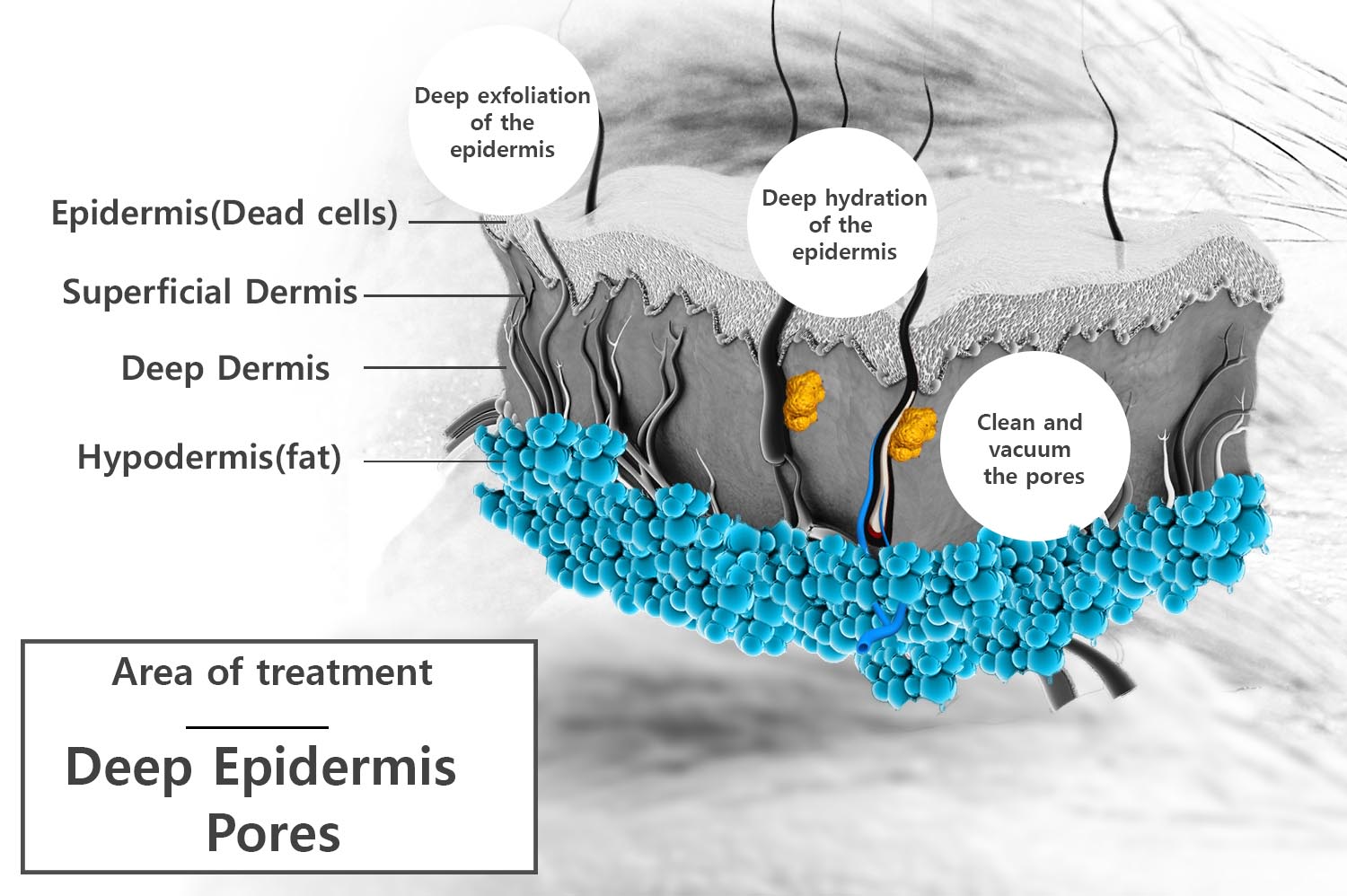 hydrafacial-treatment-area-pores-epidermis hydrafacial-treatment-area-pores-epidermis