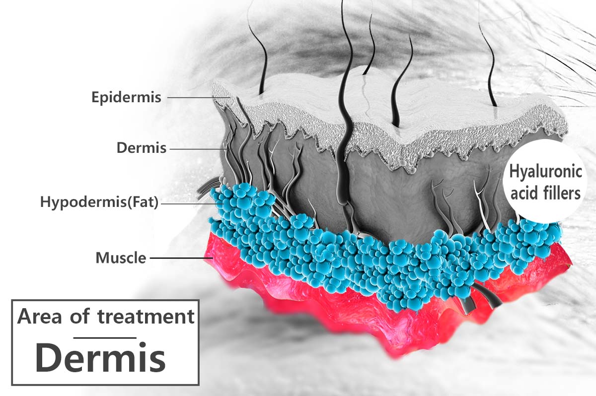 juvederm injection sites