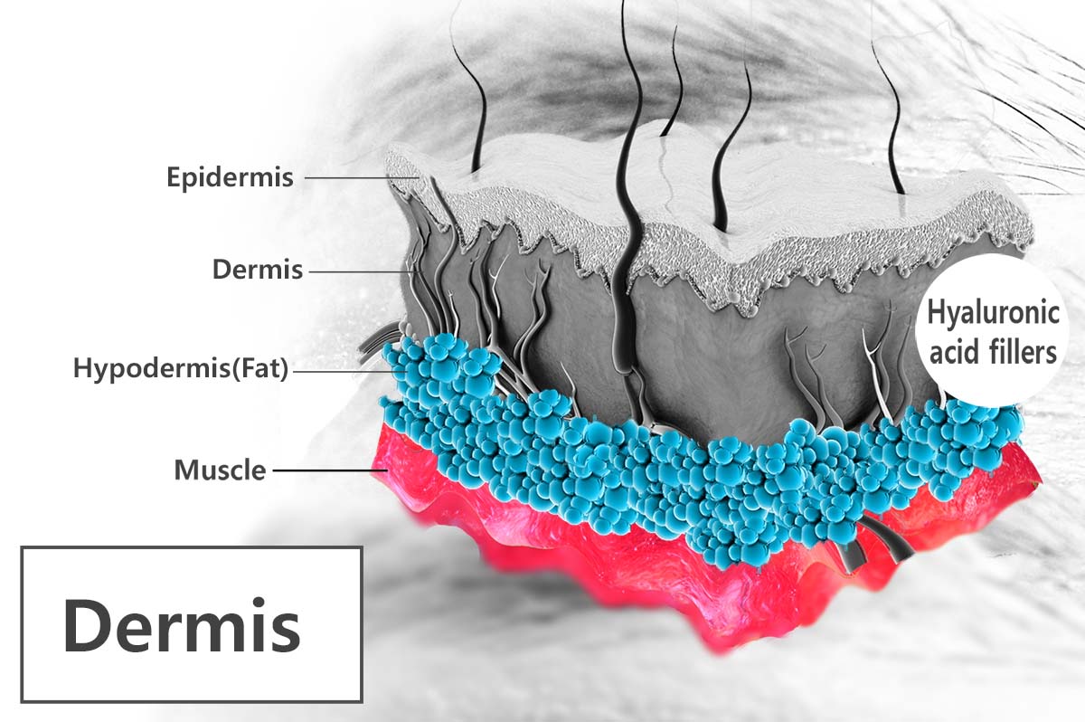 juvederm injection