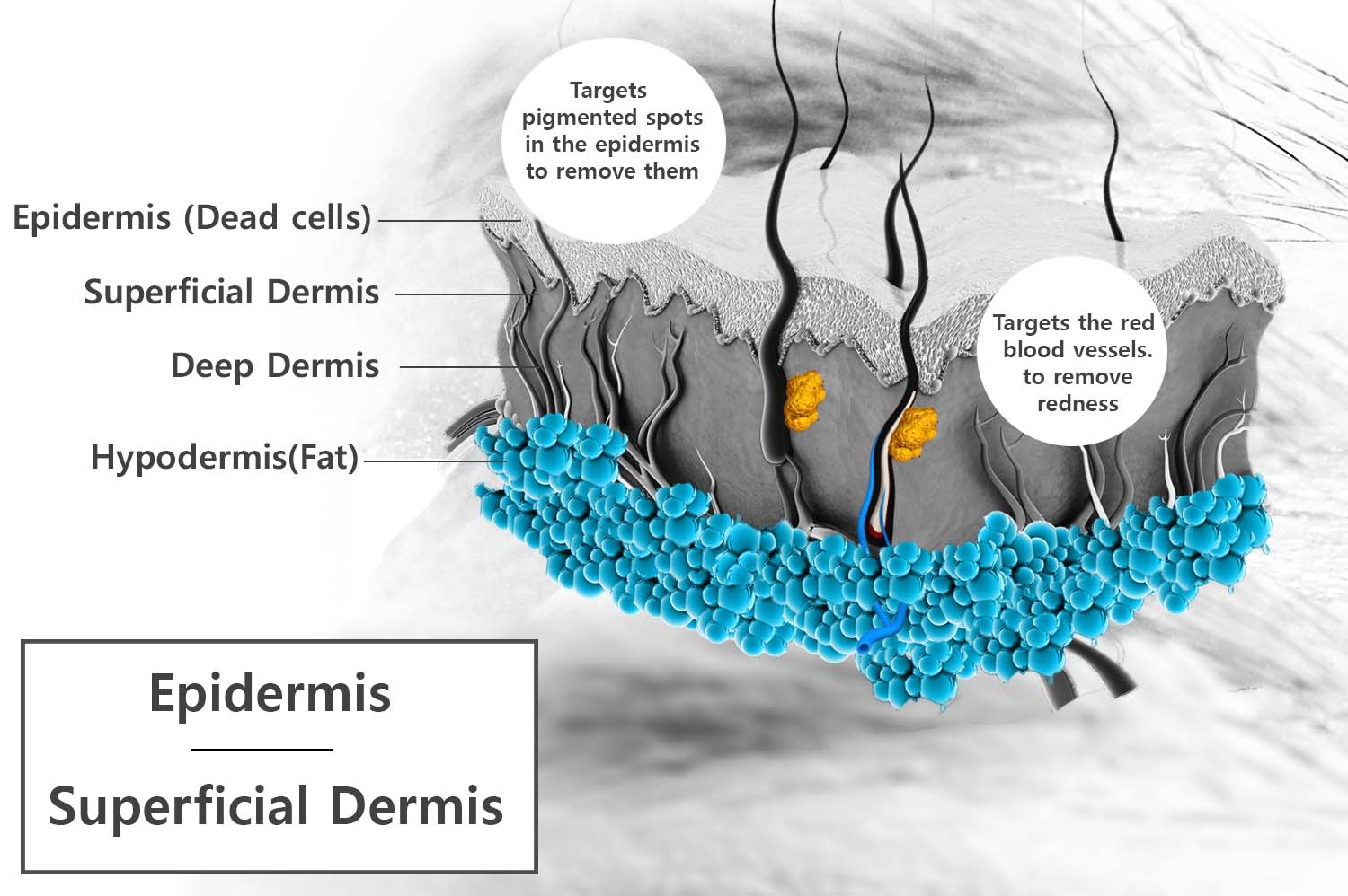 ipl -intense pulsed light