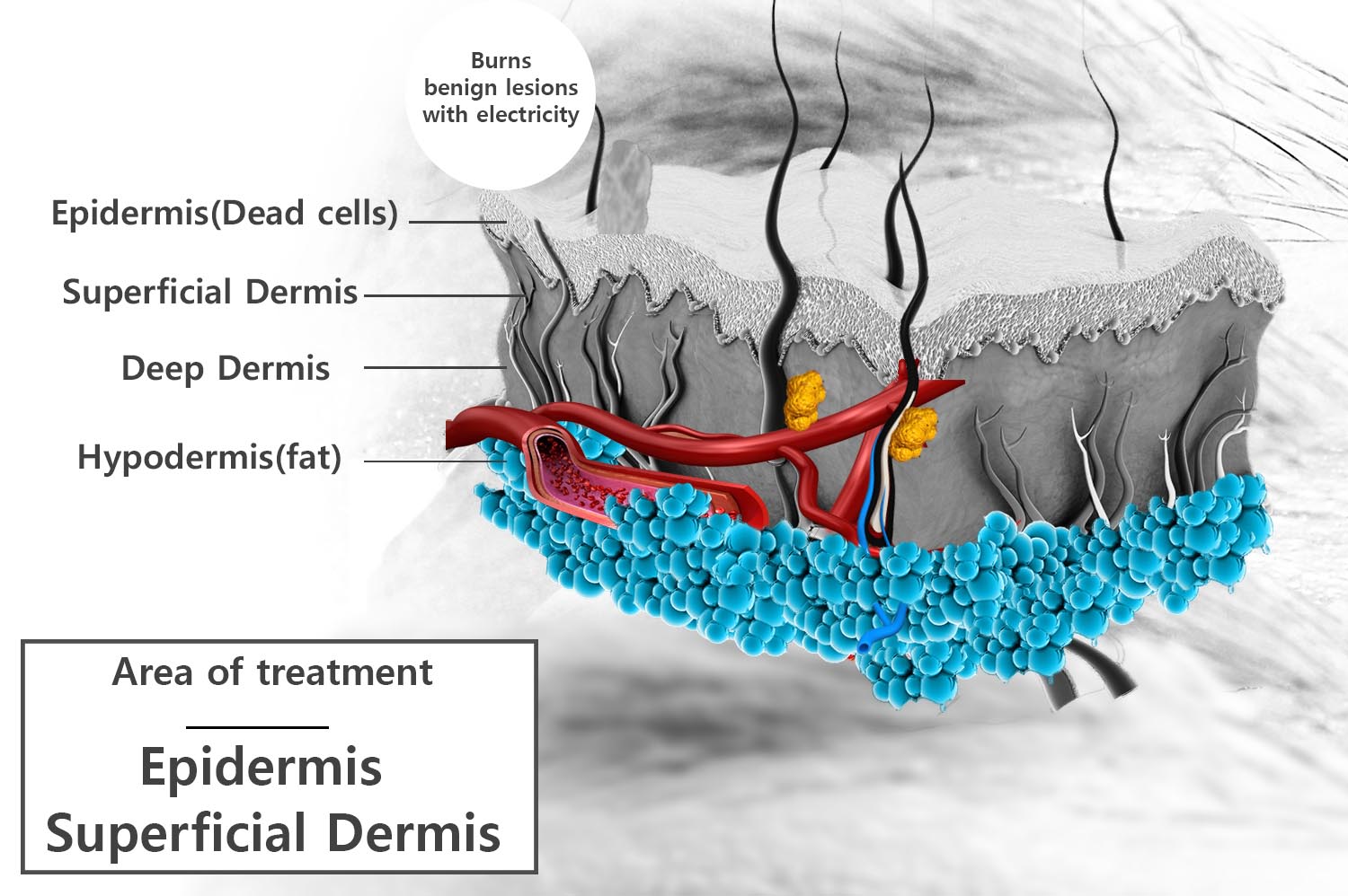 benign lesion by thermocoagulation