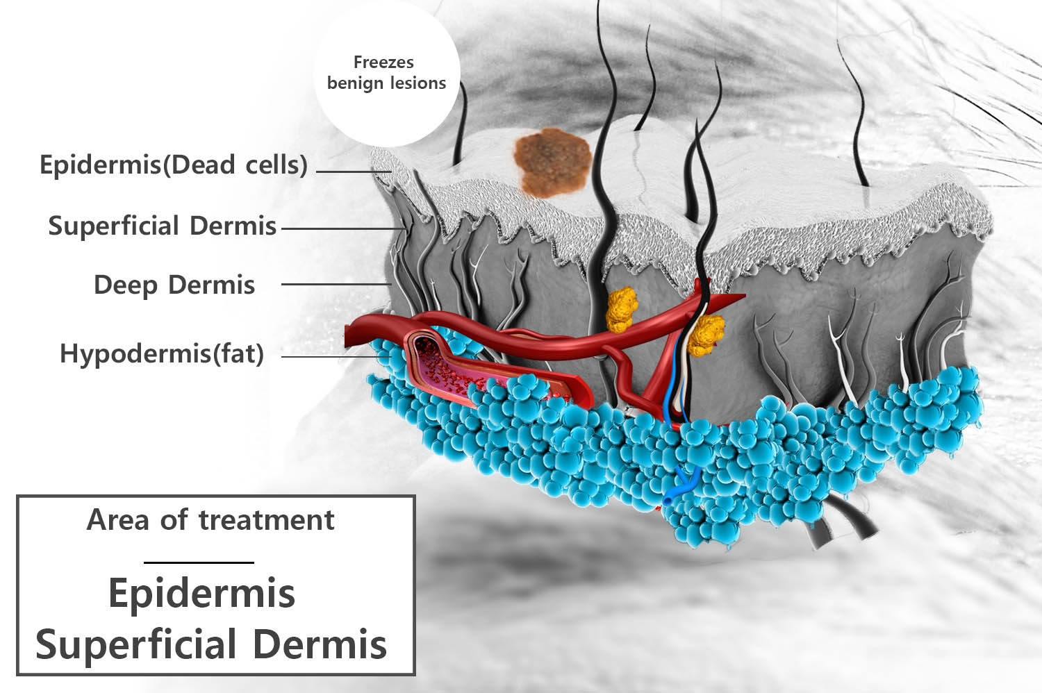 skin benign lesions – treatment removal