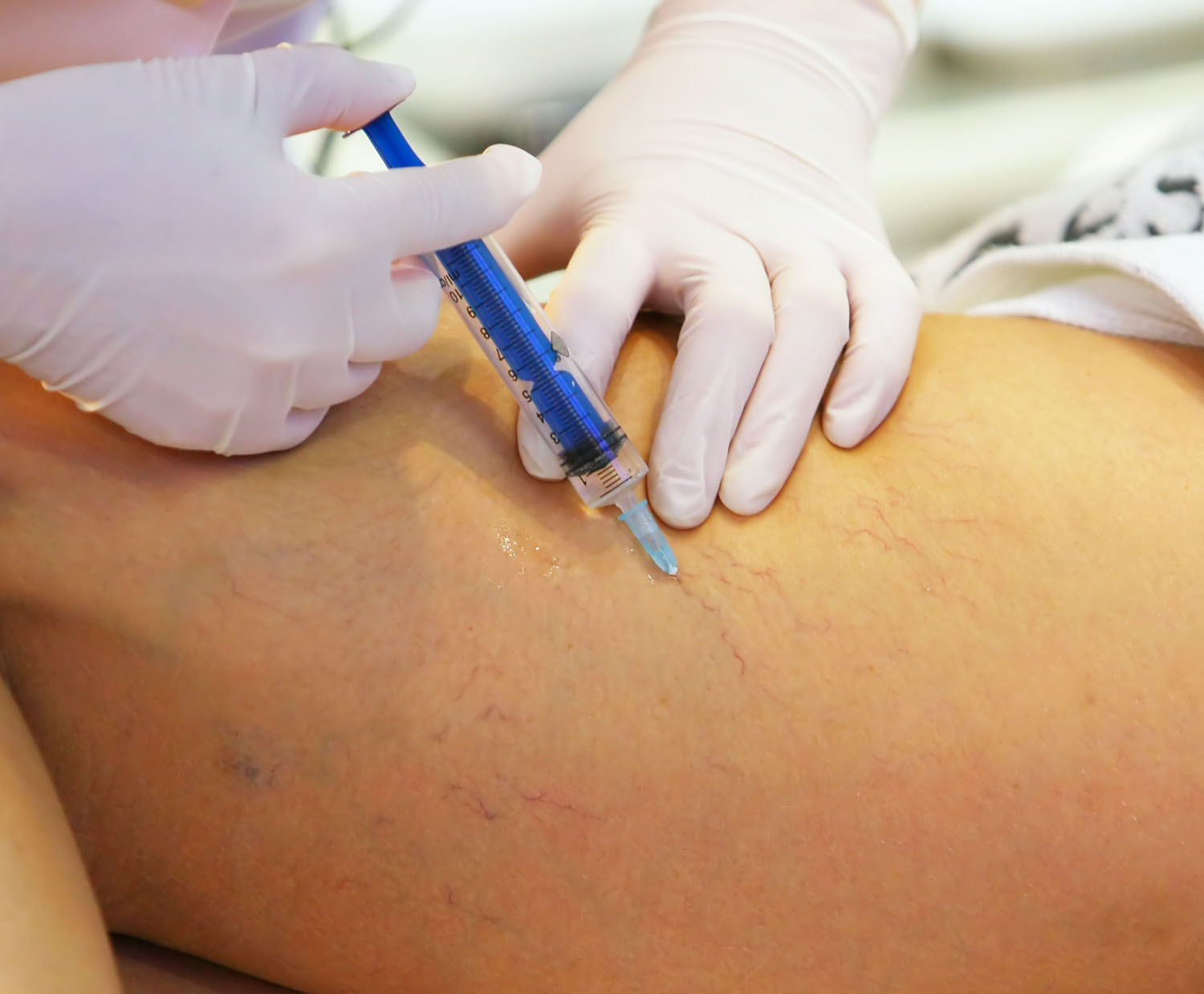 Sclerotherapy (spider Veins), Sima Medical & Cosmetic Clinic