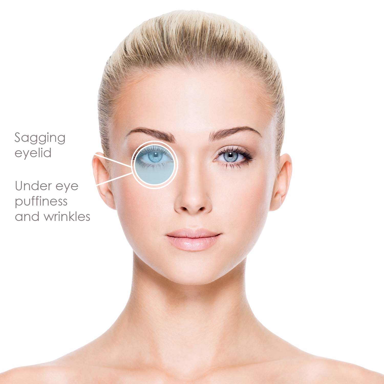 undereye-puffiness-wrinkles-sagging-eyelid