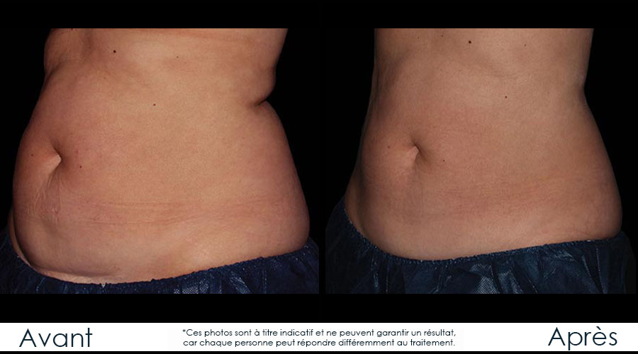avant-apres-coolsculpting1