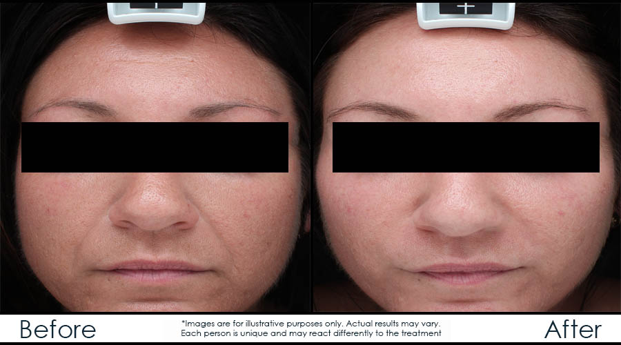 before-after-en-juvederm2