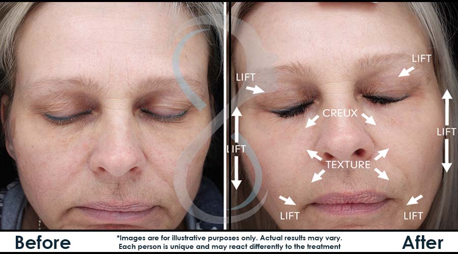 Fine Lines and Wrinkles - Lift Skin Health & Laser