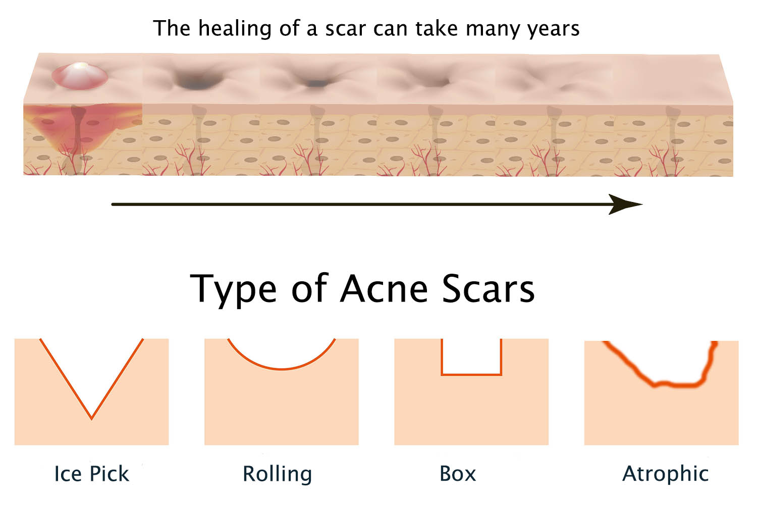 acne scar type
