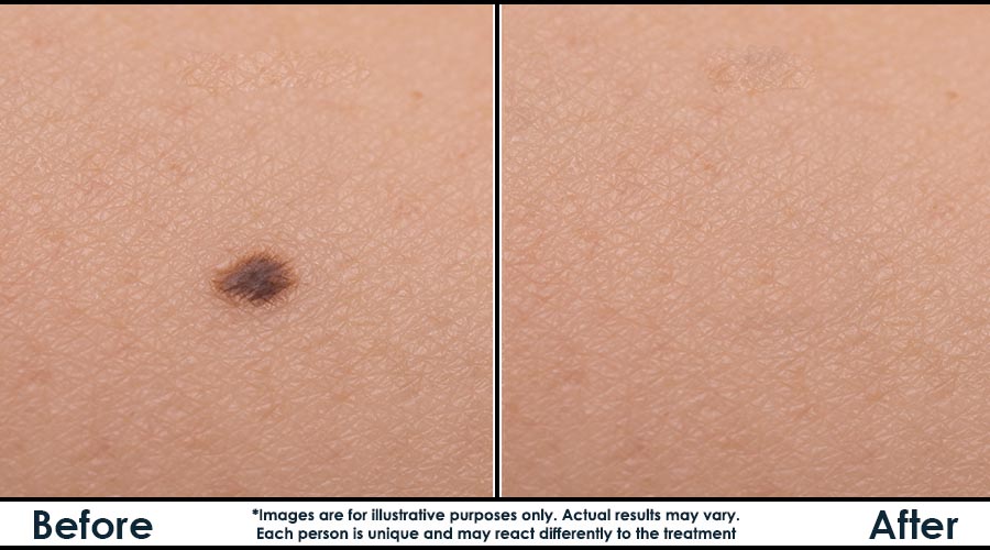 mole-before-after