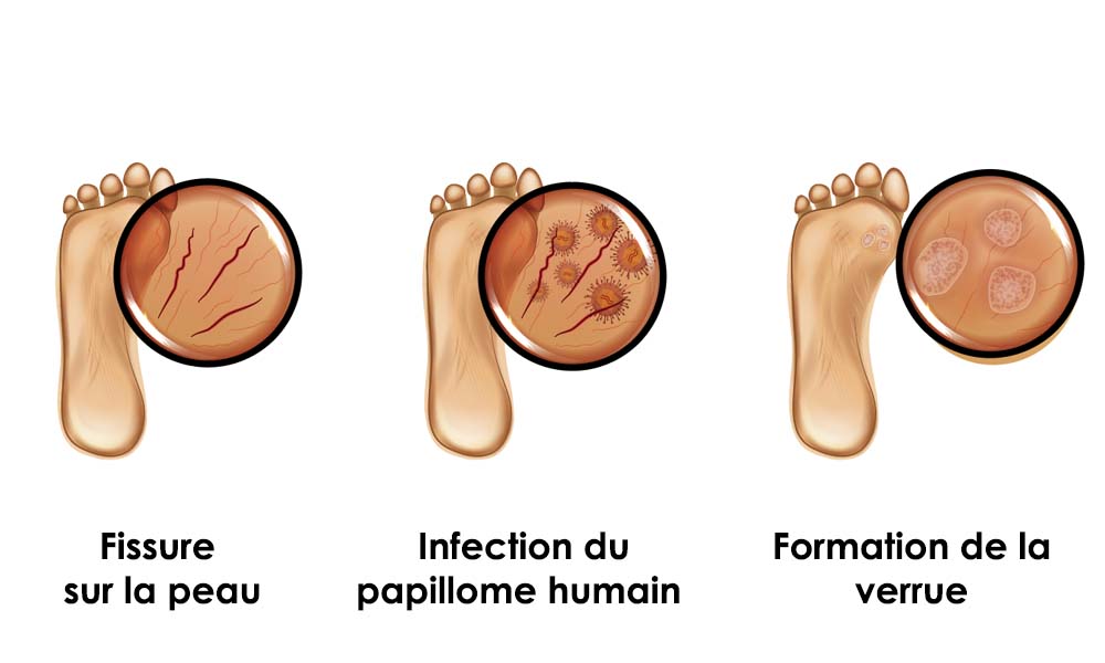 Verrue plantaire - Pied Outaouis