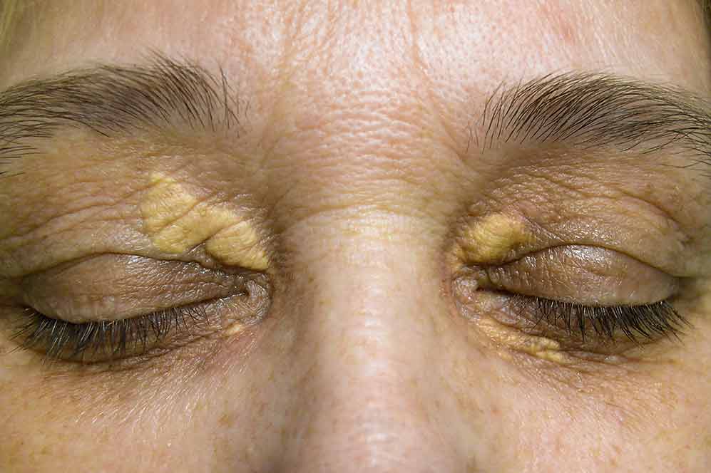 xanthelasma-exemple