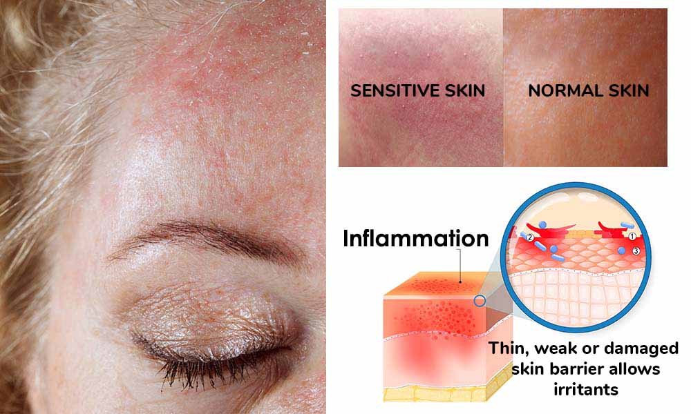 sensitiveskin