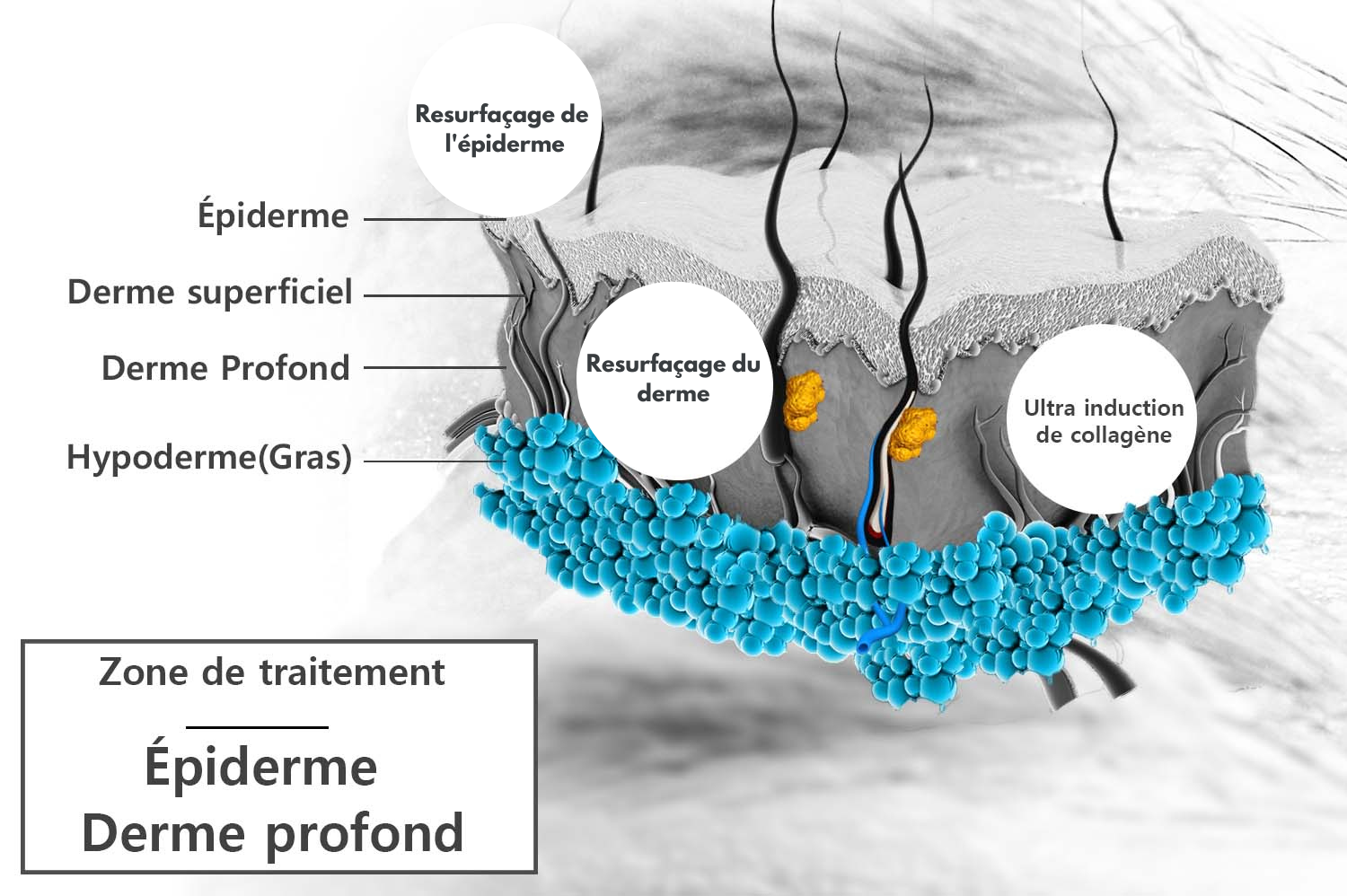 resurfacage-de-lpiderme