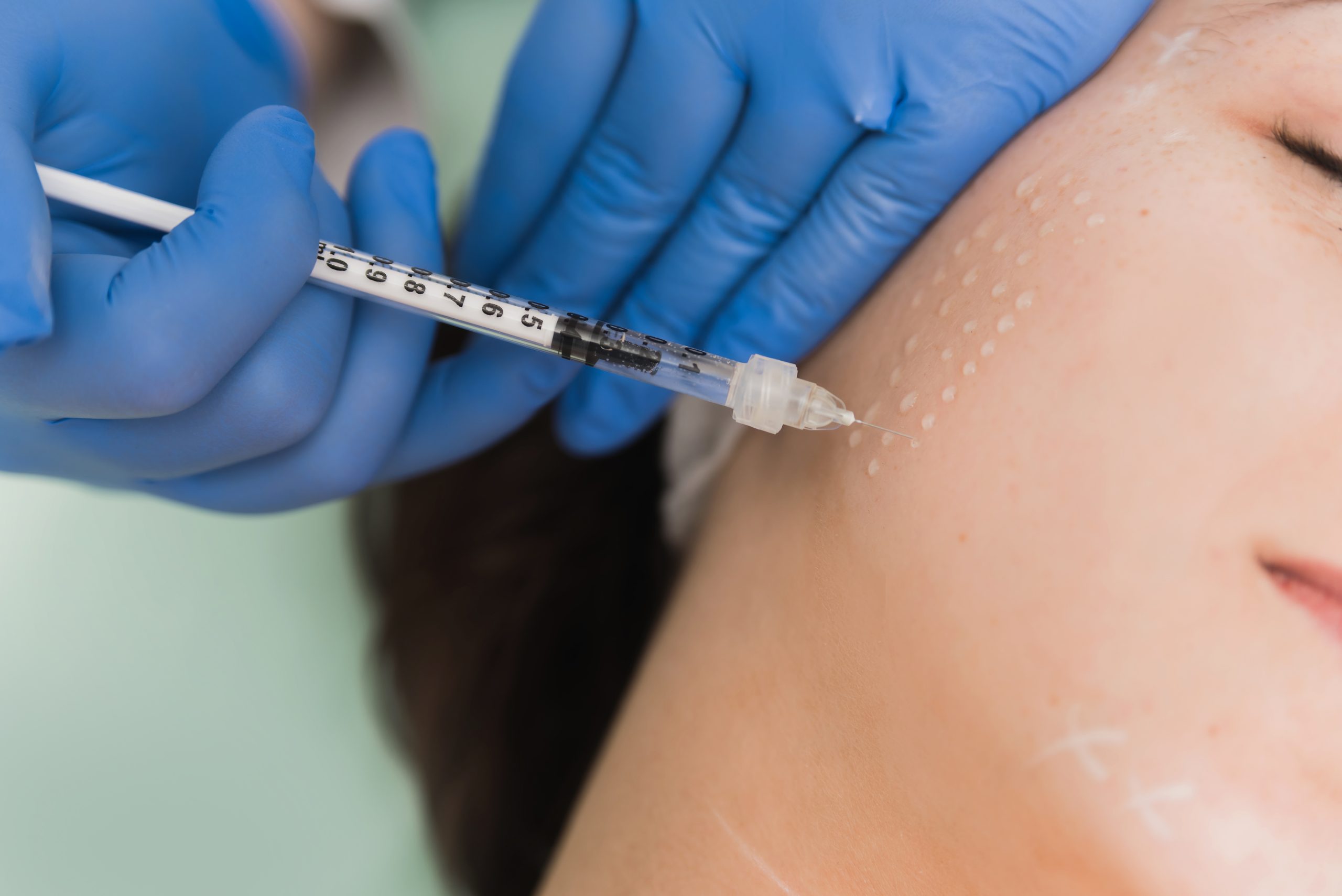 Mesotherapy treatment Mesotherapy treatment