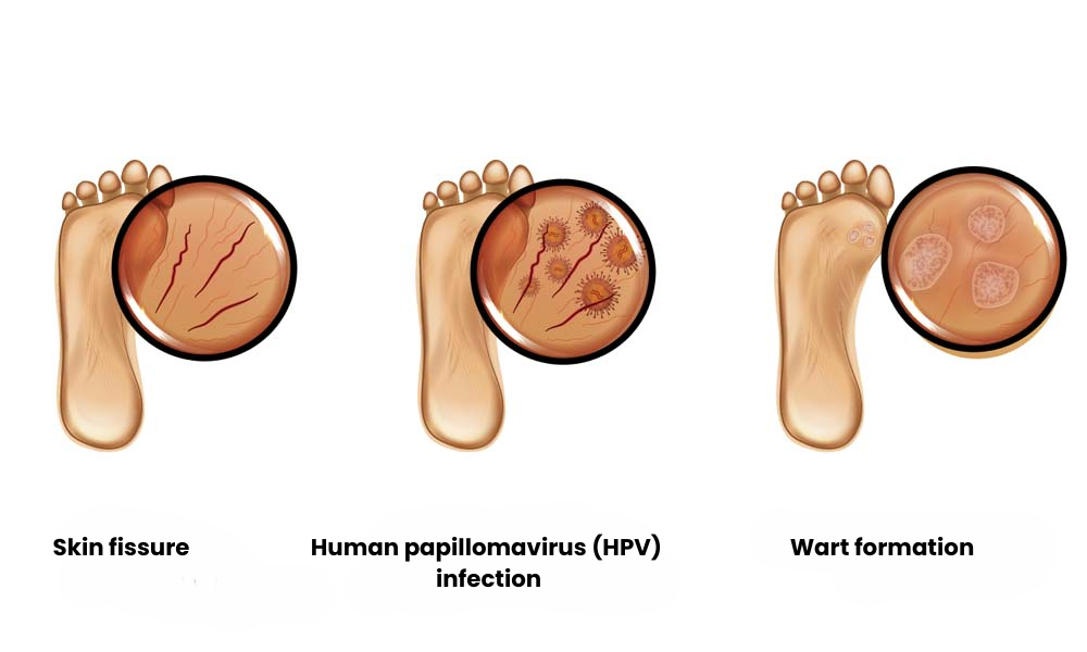 wart-formation wart-formation