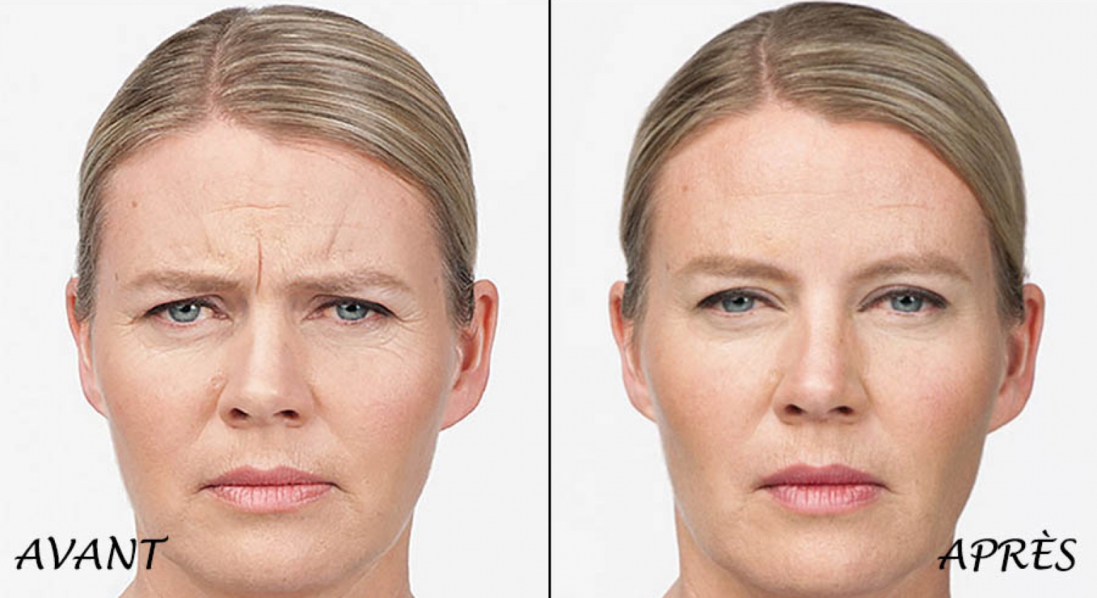 Traitement cellulite par endermologie au Canada Gatineau, Ottawa