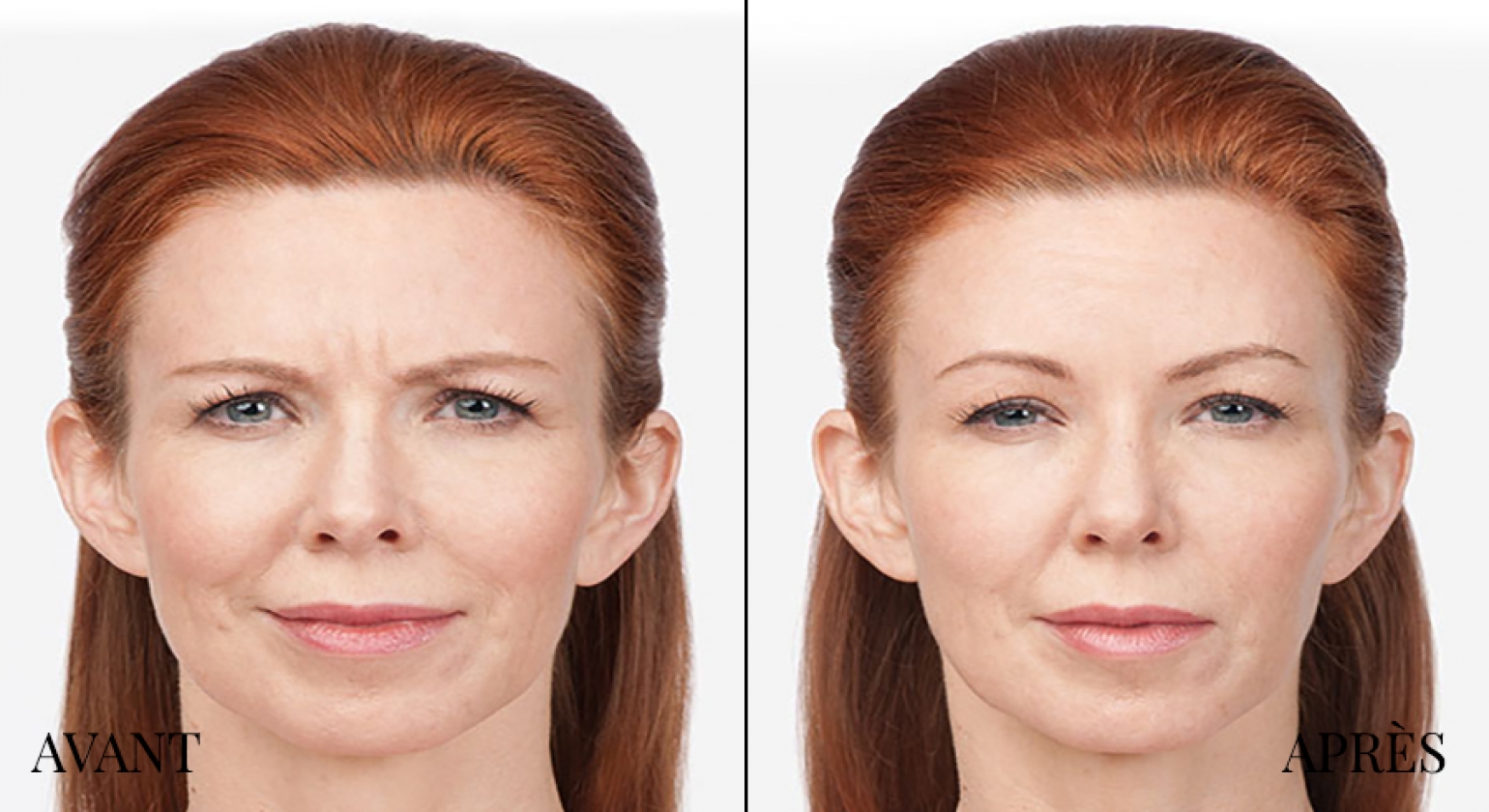 Endermologie Cellulite Treatment Ottawa, Gatineau
