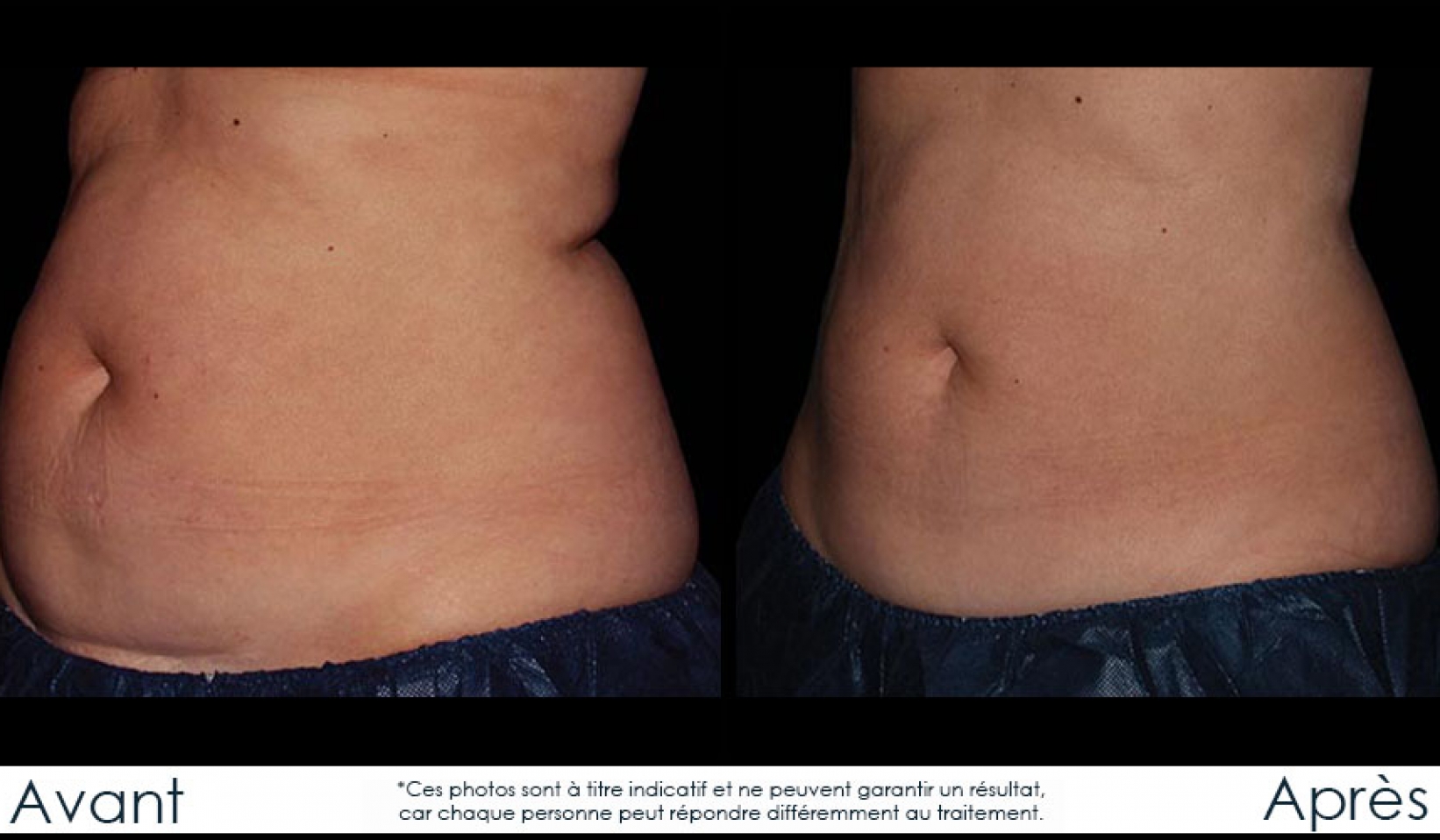 Coolsculpting Réduction des graisses Gatineau,Ottawa