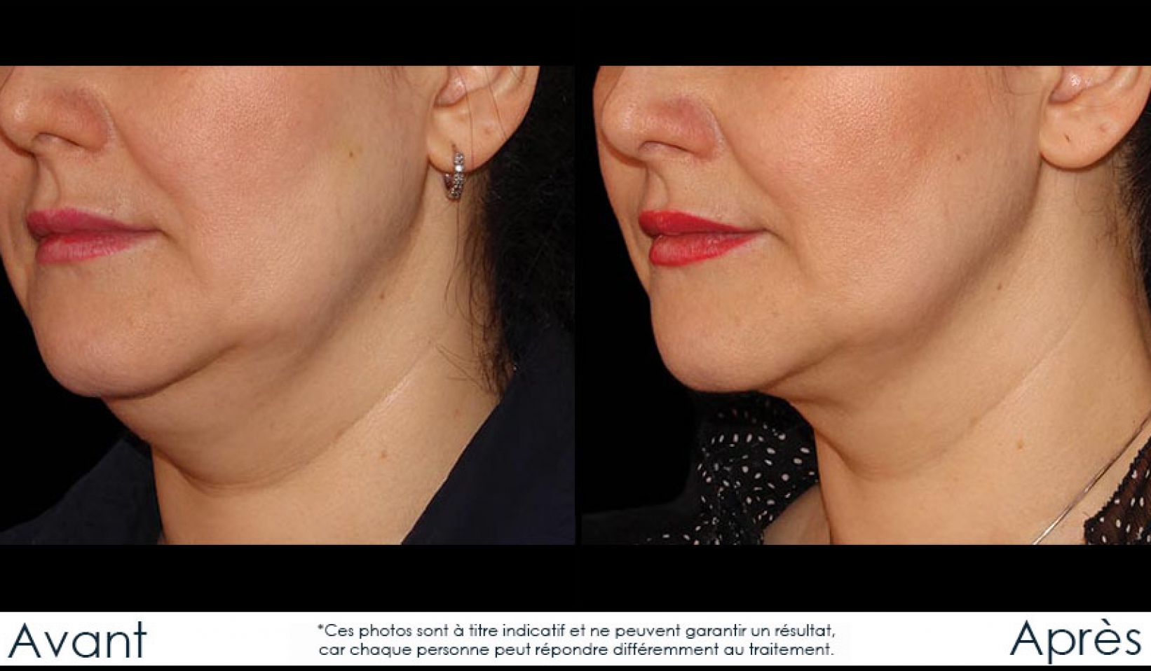 Coolsculpting Réduction des graisses Gatineau,Ottawa