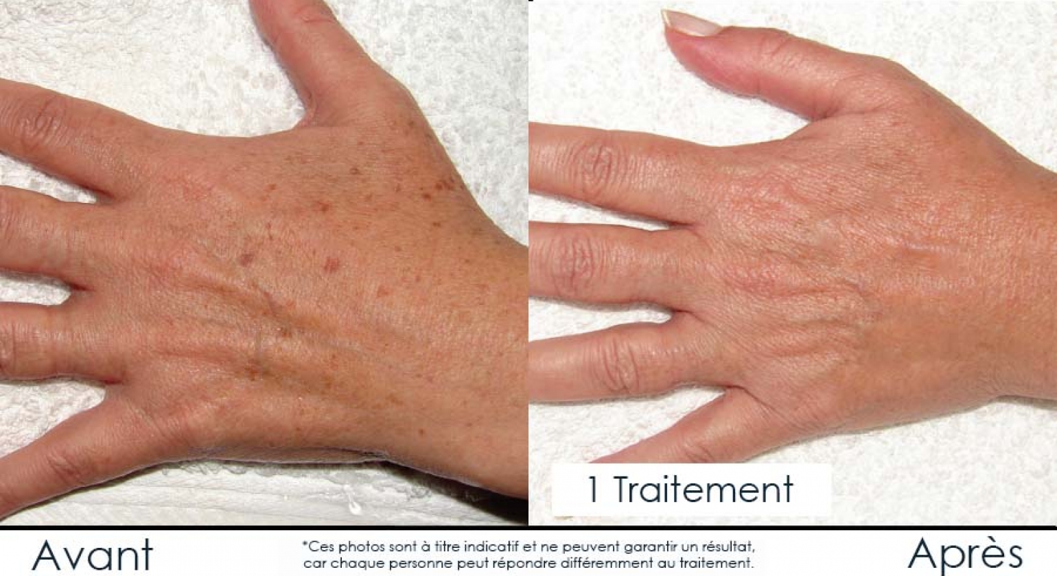 Lumière pulsée IPL pour soigner rougeurs et taches brunes à Hull